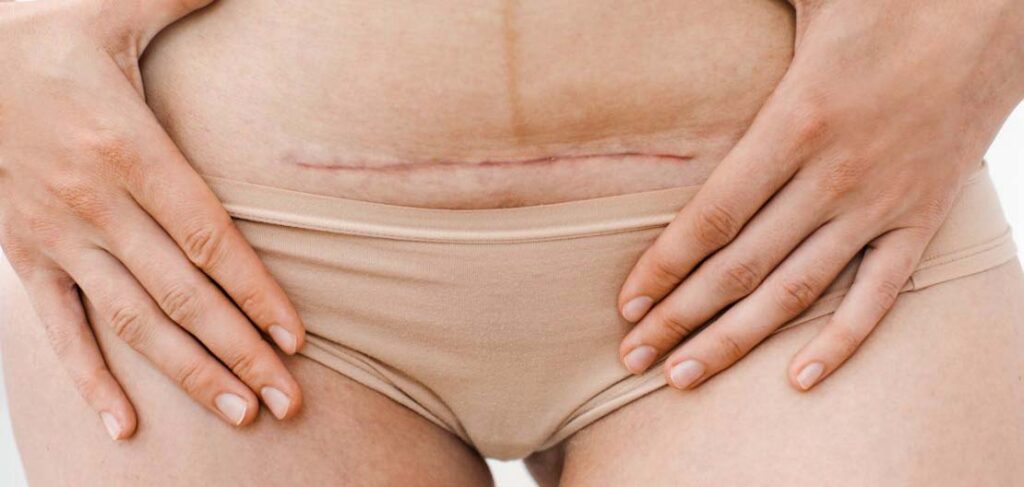 Premiers soins cicatrice césarienne : femme tenant son bas-ventre, cicatrice de césarienne horizontale au-dessus de la culotte, post-partum