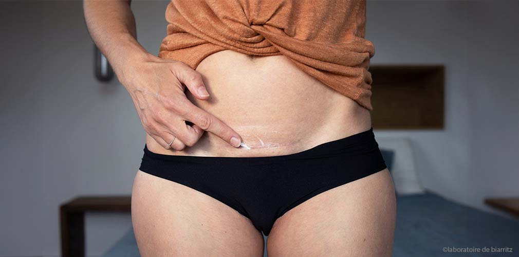 Étapes des soins de la cicatrice de césarienne : femme appliquant un soin topique sur sa cicatrice horizontale avec le doigt
