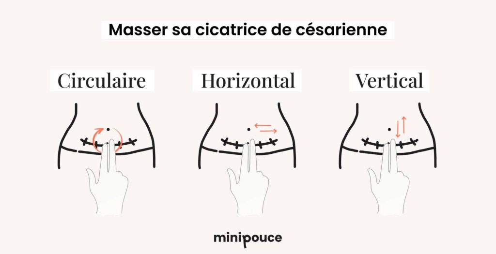 Massage cicatrice césarienne : schéma des 3 techniques de massage, circulaire, horizontal et vertical, pour favoriser la cicatrisation après césarienne