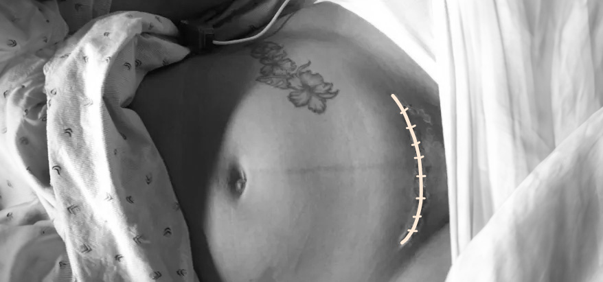 Soins post-césarienne à la maternité : cicatrice de césarienne fraîche avec agrafes, aspect normal de la plaie opératoire dans les premiers jours après l'accouchement